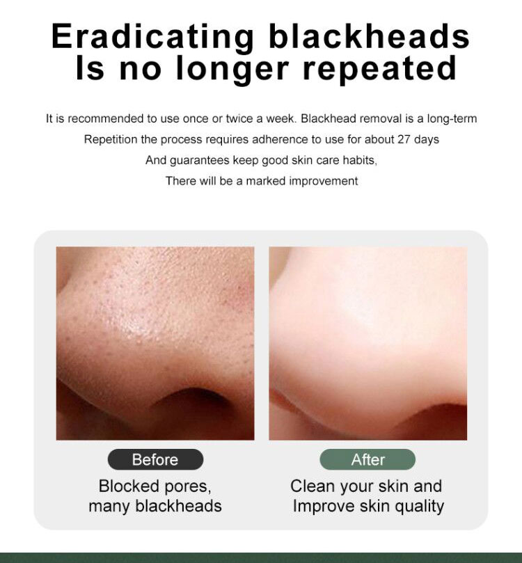 Mango blackhead remover (6)